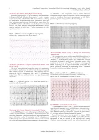 lv endocardium|endocardial lv pacing chart.